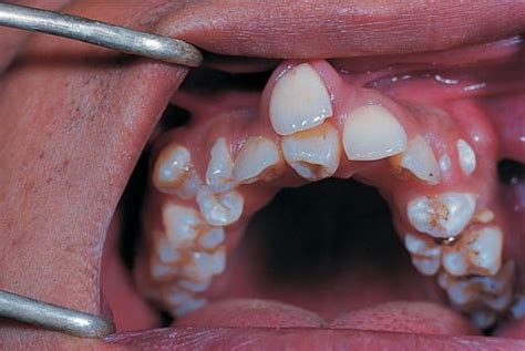 hyperdontia - Google Search | 歯, 過剰歯