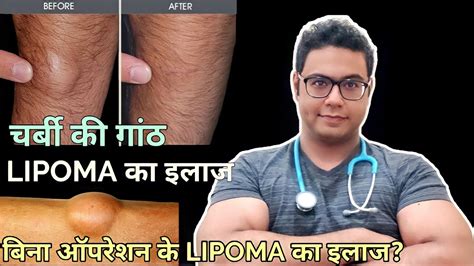 Doctor Explains Lipoma Treatment Without Surgery And With Surgery