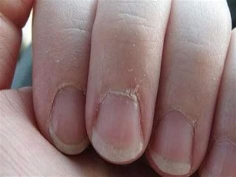 Beauty Tips Amazing Home Remedies To Get Rid Of Peeling Cuticles