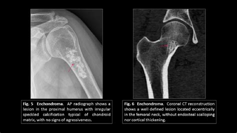 Figure 4 From Enchondroma Vs Low Grade Chondrosarcoma Where Are