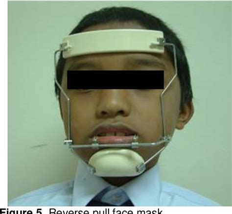 Figure 1 From Effectiveness Of Treatment With Reverse Twin Block And Reverse Pull Face Mask On