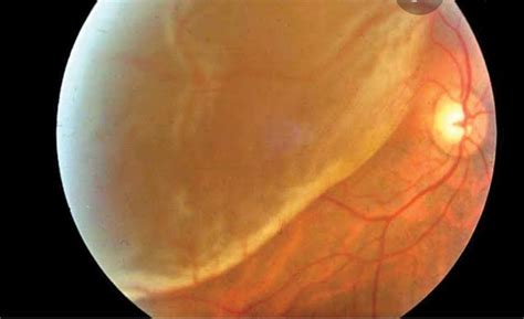 Slit Lamp Examination Technique And Illumination Type