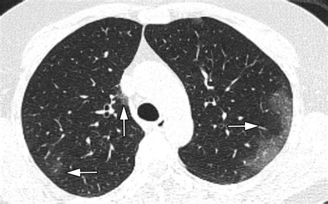 Implications Of Sex Difference In Ct Scan Findings And Outcome Of