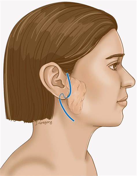 Salivary Gland Tumors Types Risk Factors Procedure And Treatment