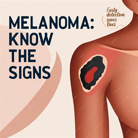 Managing Melanoma Causes Symptoms and Treatment | Premium AI-generated