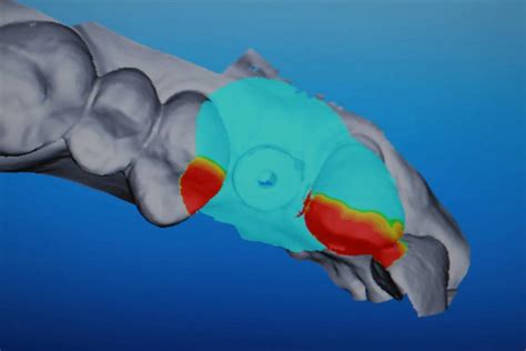 5 Axis Dental Design Center Scanning Jig For Itero Bone Level Implant