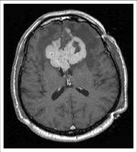 T 1 Weighted Axial Brain Magnetic Resonance MR Imaging Demonstrating