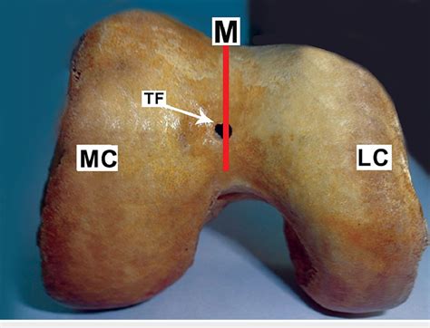 Vascular Trochlear Foramen In The Midline On The Trochlear Groove Of