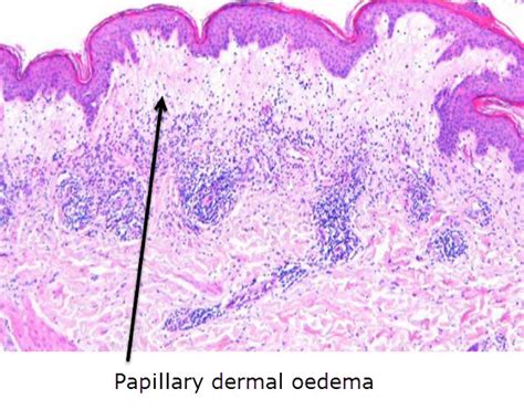 Differential Diagnosis In Dermatopathology April 2014