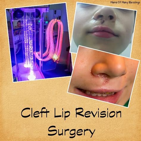 Cleft lip Revision Surgery ~ Ethan's Cleft Lip / Palate Journey