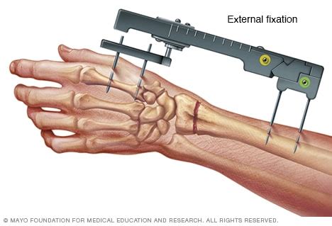 Fractura de muñeca Diagnóstico y tratamiento Mayo Clinic