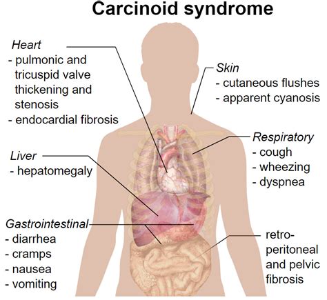 Carcinoid Tumors and Syndrome | Concise Medical Knowledge