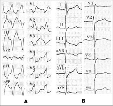 12 Lead Surface Ecg During Tachycardia A And After Cardioversion B Download Scientific