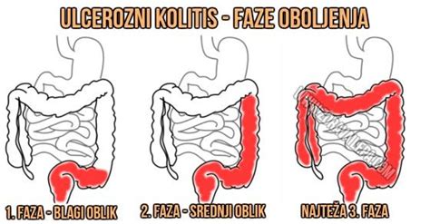 Upala debelog creva simptomi ishrana lečenje kolitisa