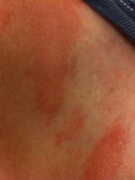 Red Rash Around Neckline Pictures Photos