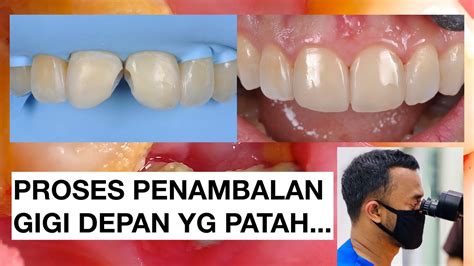 Proses Penambalan Gigi Depan Yang Patah Tambal Gigi Dokter Gigi