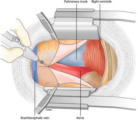 Minimally Invasive Aortic Valve Surgery Intechopen