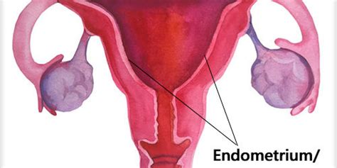 Endometrial Hyperplasia – Causes & Treatment | GAURI - Urogynecology Clinic