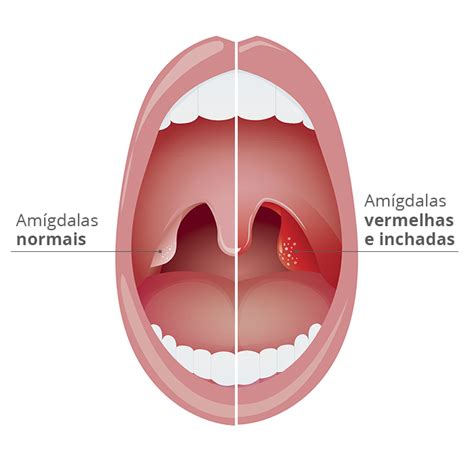 Amigdalite Sintomas Tratamento E Preven O