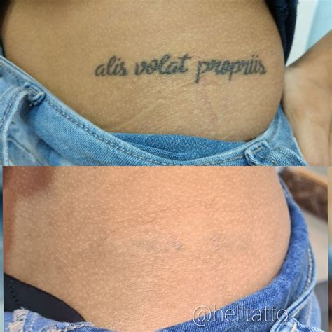 Antes e Depois de Remoção de Tatuagem HellTattoo