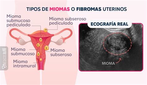 Miomas Quito Diagn Stico Preciso Y Tratamiento