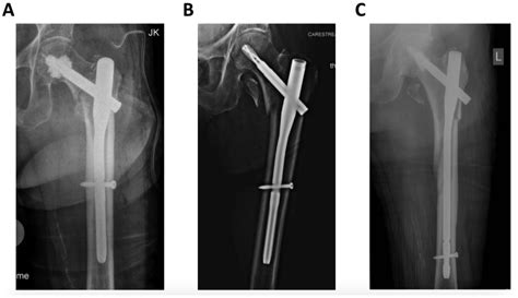 Lesser Trochanter Fracture