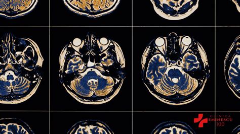 RMN Cerebral Imagistica Neurologica Avansata Clinica Eminescu 100