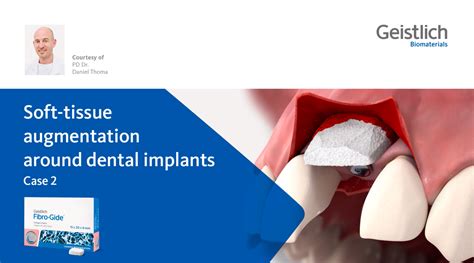 Soft Tissue Augmentation Around Dental Implants Uk