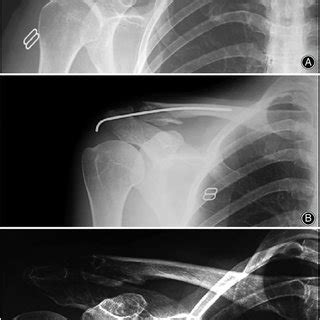 (A) Preoperative x-ray showing a patient with mid clavicular fracture ...