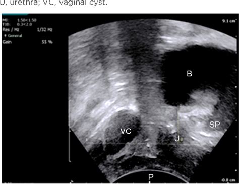 Figure 1 From The Value Of Pre Operative Multicompartment Pelvic Floor