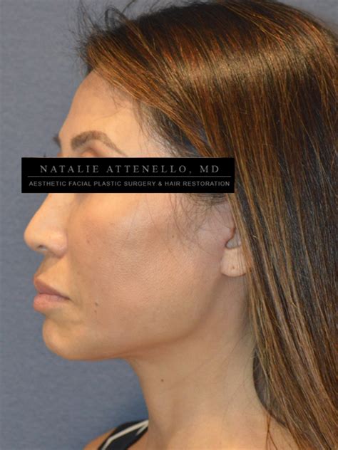 Beverly Hills Facelift Before And After Photos Los Angeles Plastic