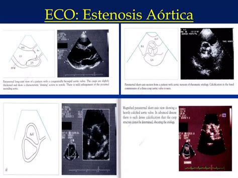 Estenosis Aortica Ppt