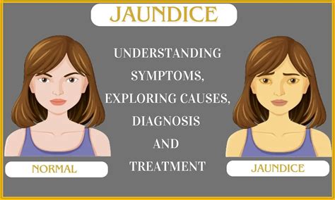 Jaundice Understanding Symptoms Exploring Causes Diagnosis And Treatment