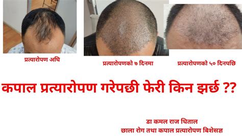 Hair Loss After Hair Transplant In Nepal And Hair Transplant Results In