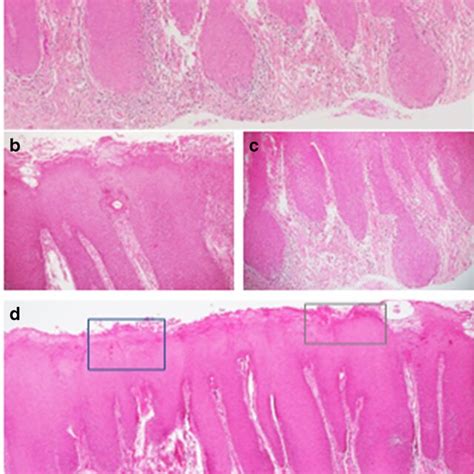 Prevalence of chronic hyperplastic candidiasis-associated contributing ...