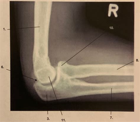 R Ntgen Ellbogen Lateral Flashcards Quizlet