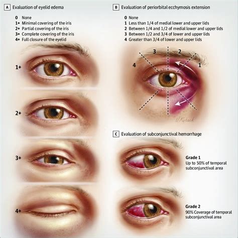 Differences In Postoperative Eyelid Edema Periorbital Ecchymosis And Download Scientific