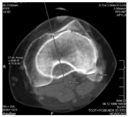 SciELO Brasil Irreducible Acute Patellar Dislocation Due To A New