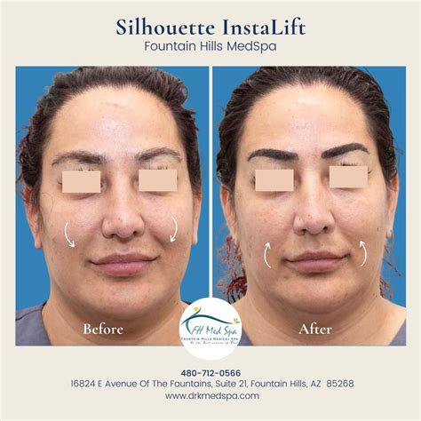 Silhouette InstaLift Non Surgical Skin Lift Fountain Hills Med Spa