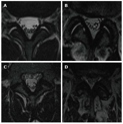 Facet Joint Arthropathy Mri