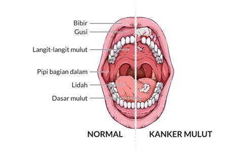 Kanker Mulut Gejala Penyebab Dan Mengobati Alodokter