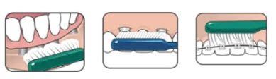 TePe® Implant Orthodontic Brush - Designed to Clean Along Implants and ...