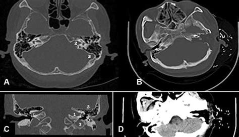 A The Axial Ct Shows The High Jugular Bulb The Enlarged Internal