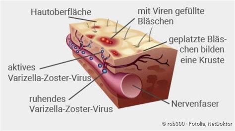 G Rtelrose Herpes Zoster Ansteckung Symptome Behandlung Netdoktor