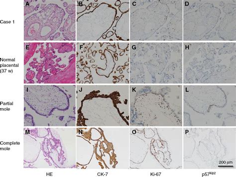 Prenatal Imaging And Pathology Of Placental Mesenchymal Dysplasia A