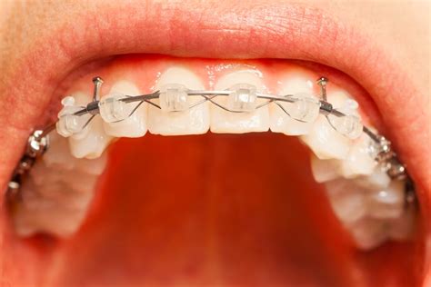 How To Get Rid Of Gingivitis With Braces