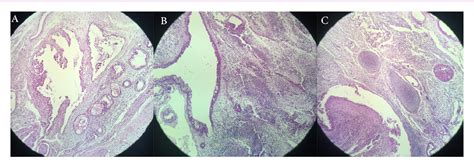 Figure 2 From A Massive Congenital Intracranial Orbital Immature