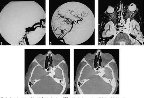 Figure 1 From Management Of A Rare Complication Of Endovascular Treatment Of Direct Carotid