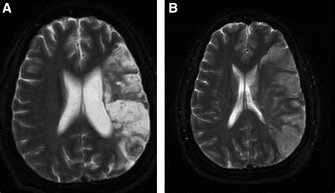 Wernickes Aphasia Mri