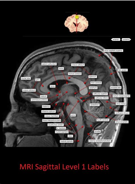 Mri Sagittal Anatomy Of Brain Level 1 Nclex Quiz Brain Anatomy Mri